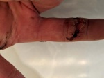 Pre-Surgery
